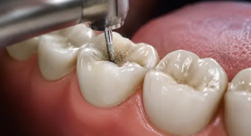 Filling (Cavity Treatment) at Twins Dental Clinic