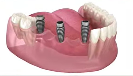 Dental Implant at Twins Dental Clinic