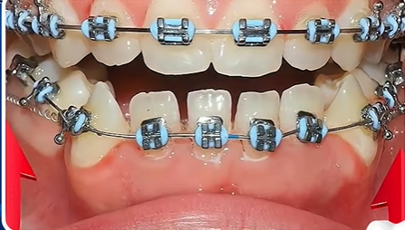 Braces Treatment at Twins Dental Clinic